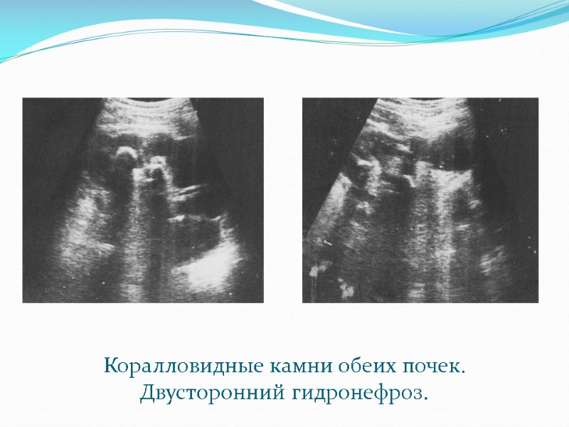 Коралловидные камни обеих почек. Двусторонний гидронефроз.